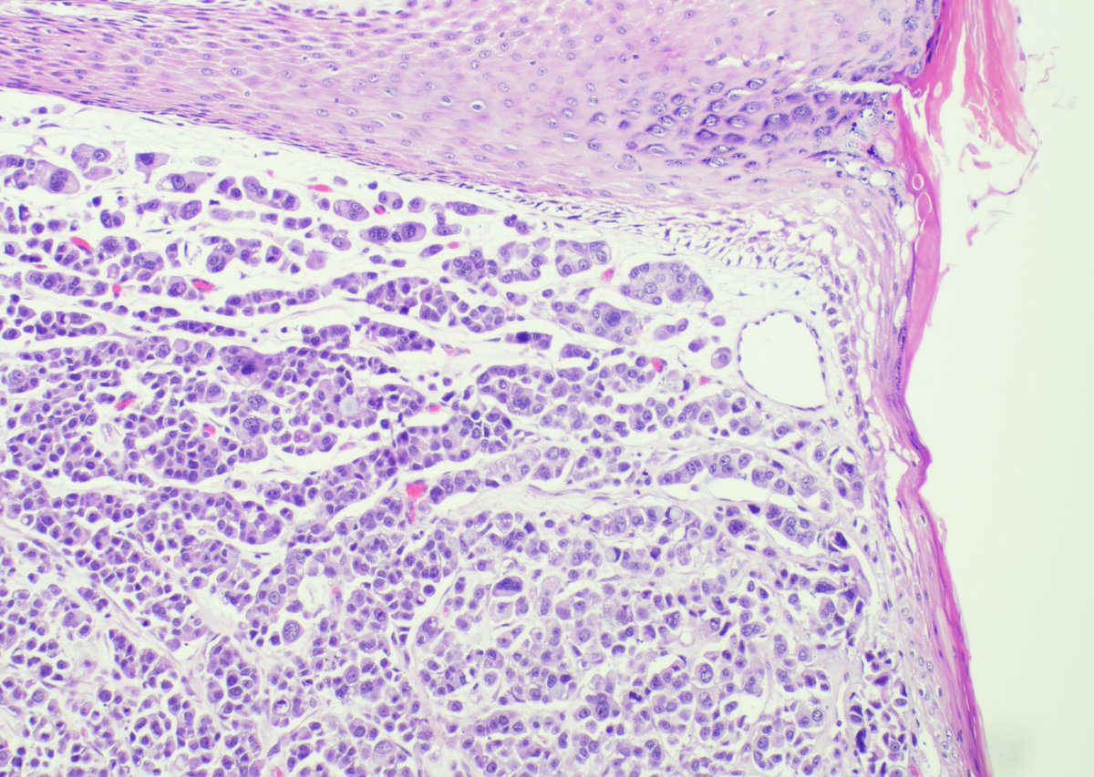 SandraIxchelS's tweet image. Pleomorphic lobular carcinoma involving skin 

#breastpathology #pathology