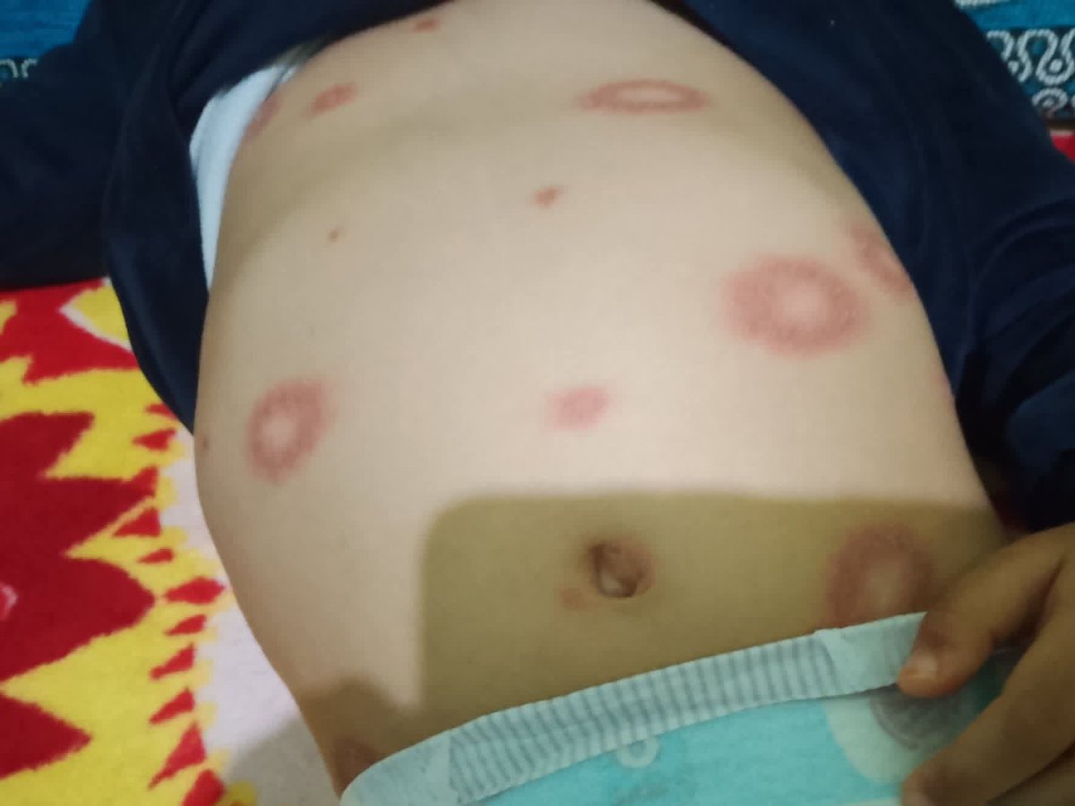 hmd_mhmd9832's tweet image. My child has infections all over her body. She is in a lot of pain She screams loudly, and my heart breaks when I see her like this. 🥹😭