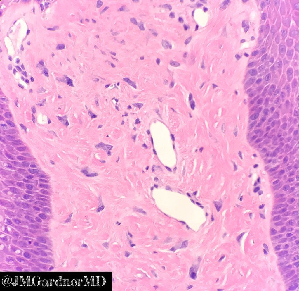 JMGardnerMD's tweet image. Solitary face lesion in adult. Clinical: r/o BCC. Diagnosis? 
What if it were a child with multiple face lesions? 
Answer ✅ youtu.be/gSk7afKp2m8?si… 
#pathology #pathologists #pathTwitter #dermpath #dermatology #dermatologia #dermtwitter