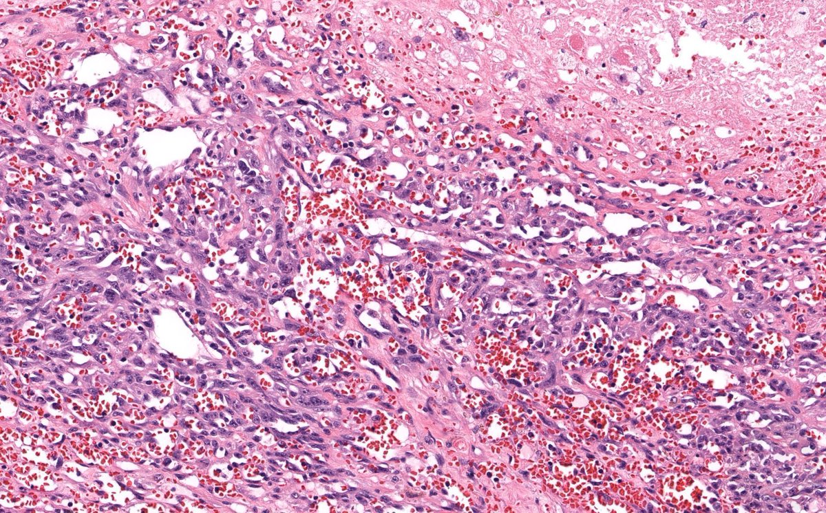 JMGardnerMD's tweet image. 75 yo face. Can you make diagnosis from one pic, or is it #TooCloseToDiagnose? 
Answer ✅ youtu.be/A0ds9BGbxG0?si… 
WSI digital slide: kikoxp.com/posts/6802. 
#pathology #pathologists #pathTwitter #dermpath #dermatology #dermatologia #dermtwitter #BSTpath
