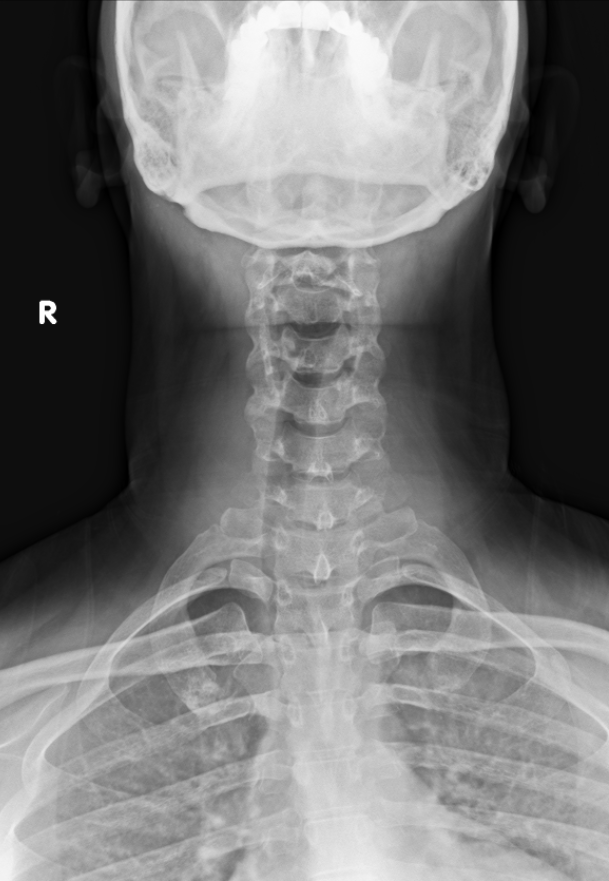 Rad_Bits's tweet photo. Quiz259: Neck pain - Thoughts?

#meded #radiology #foamed #usmle https://t.co/KQmEMKguEr