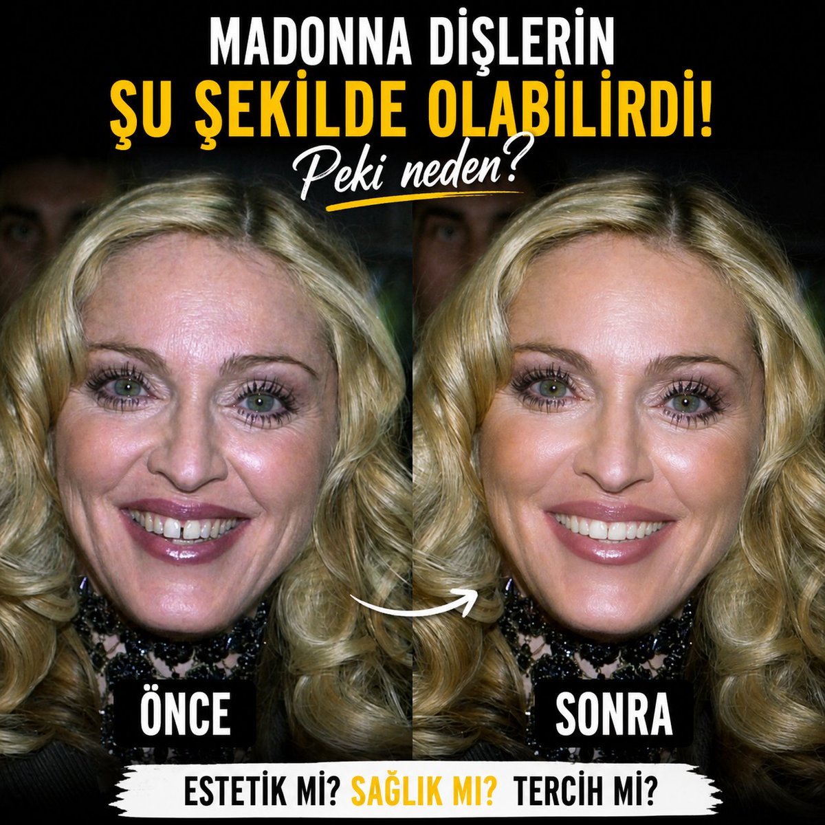 DisinOtesi's tweet photo. Kusur mu? Karakter mi?”
“1 mm bile algıyı değiştirir.”
#dişestetiği #gülüştasarımı #veneers #dişhekimi #smiledesign #öncesisonrası #estetikdiş https://t.co/sLI3HFuTCU