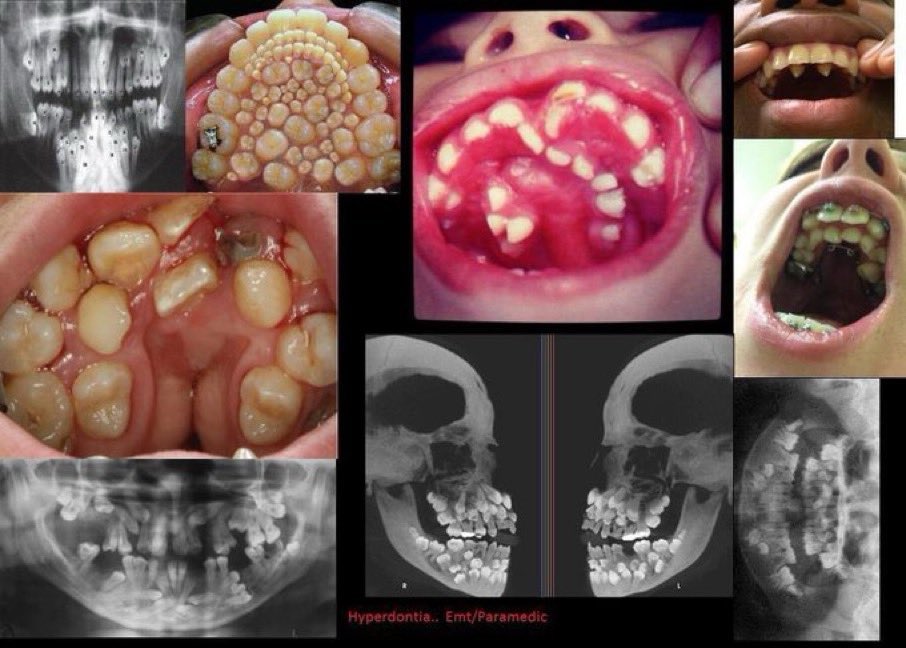 drobiy12's tweet image. What’s the maximum number of teeth you’ve seen before in an human 

#Medx #dentist