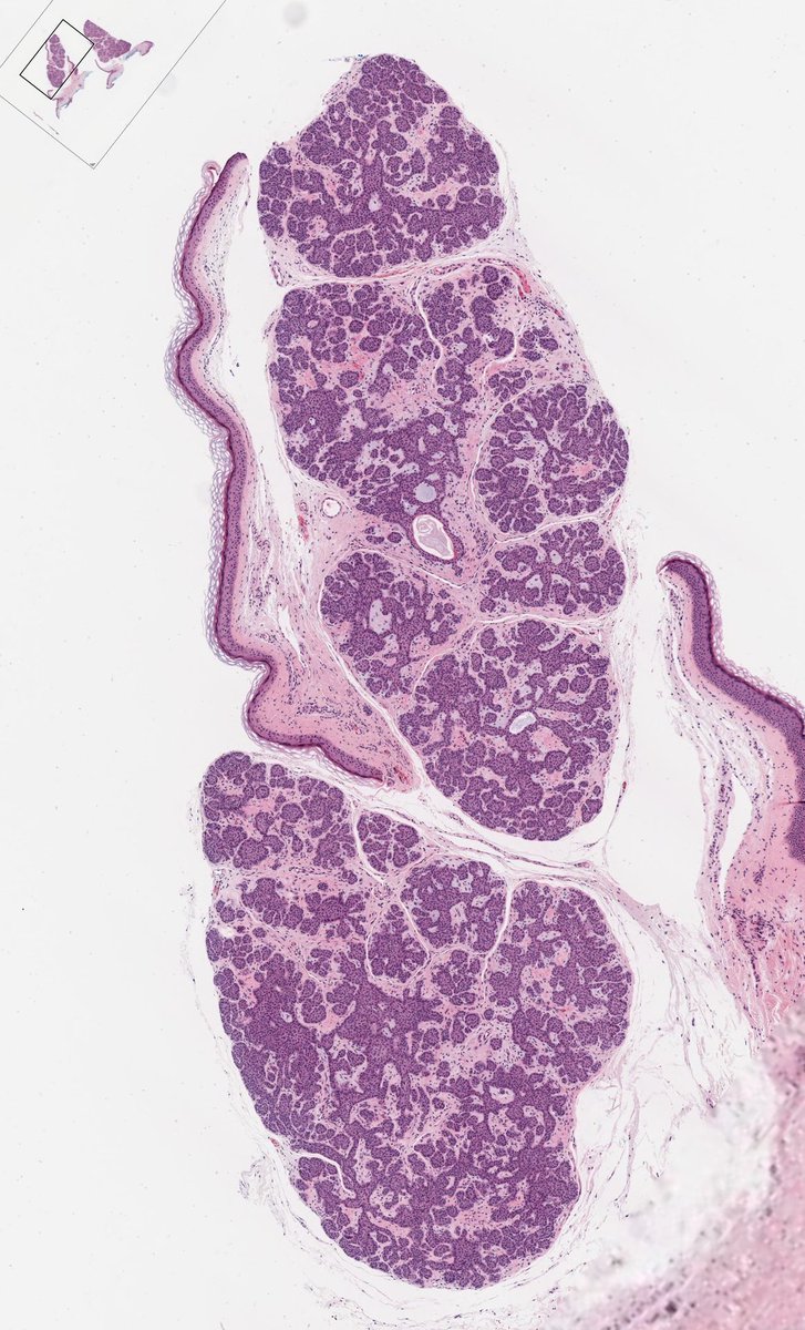 JMGardnerMD's tweet image. Adult with "skin tag" on trunk. Diagnosis? (hint: it's not a tag!)
Answer ✅ youtu.be/xqUv1LAA5ac?si… 
More pics &amp;amp; info: kikoxp.com/posts/11586
Another case (amazing): kikoxp.com/posts/15214
#pathology #pathologists #pathTwitter #dermpath #dermatology #dermtwitter