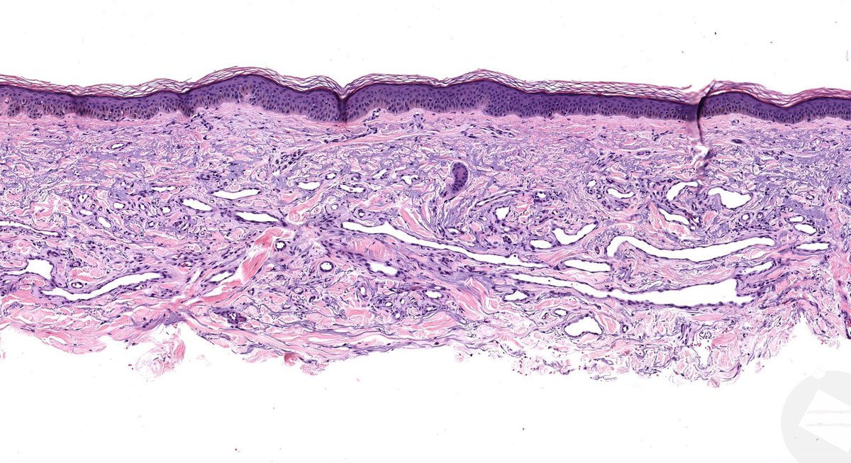 JMGardnerMD's tweet image. 60 F with red plaque on dorsal forearm.
Answer ✅ youtu.be/GnIQpFjMwqE?si… 
WSI digital slide: kikoxp.com/posts/8022 
Clinical pics: kikoxp.com/posts/8023 
#pathology #pathologists #BSTpath #pathTwitter #dermpath #dermatology #dermatologia #dermtwitter