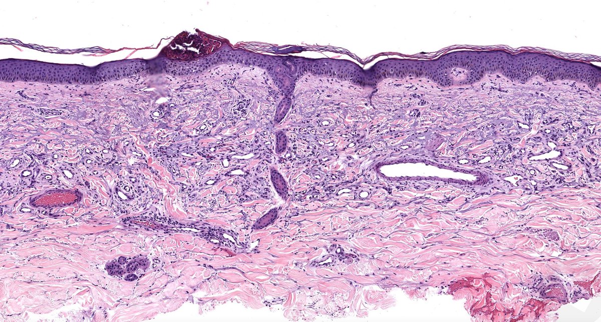 JMGardnerMD's tweet image. 60 F with red plaque on dorsal forearm.
Answer ✅ youtu.be/GnIQpFjMwqE?si… 
WSI digital slide: kikoxp.com/posts/8022 
Clinical pics: kikoxp.com/posts/8023 
#pathology #pathologists #BSTpath #pathTwitter #dermpath #dermatology #dermatologia #dermtwitter