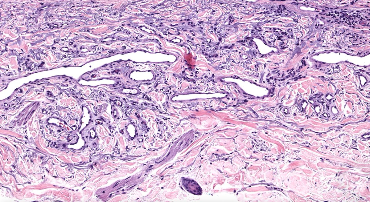 JMGardnerMD's tweet image. 60 F with red plaque on dorsal forearm.
Answer ✅ youtu.be/GnIQpFjMwqE?si… 
WSI digital slide: kikoxp.com/posts/8022 
Clinical pics: kikoxp.com/posts/8023 
#pathology #pathologists #BSTpath #pathTwitter #dermpath #dermatology #dermatologia #dermtwitter