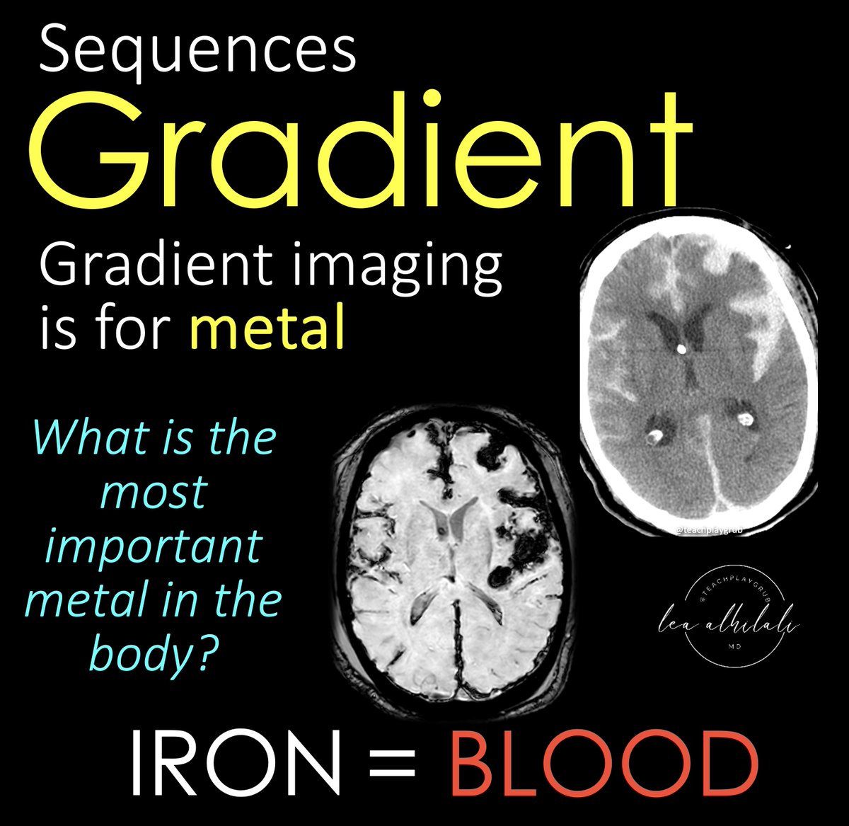 teachplaygrub's tweet photo. 17/Last but not least is gradient imaging

Gradient imaging is sensitive to metals

And what’s the most important metal in body?  Iron!! Because iron is in blood!

So gradient is our blood sensitive sequence https://t.co/ZwbPV0fXFm