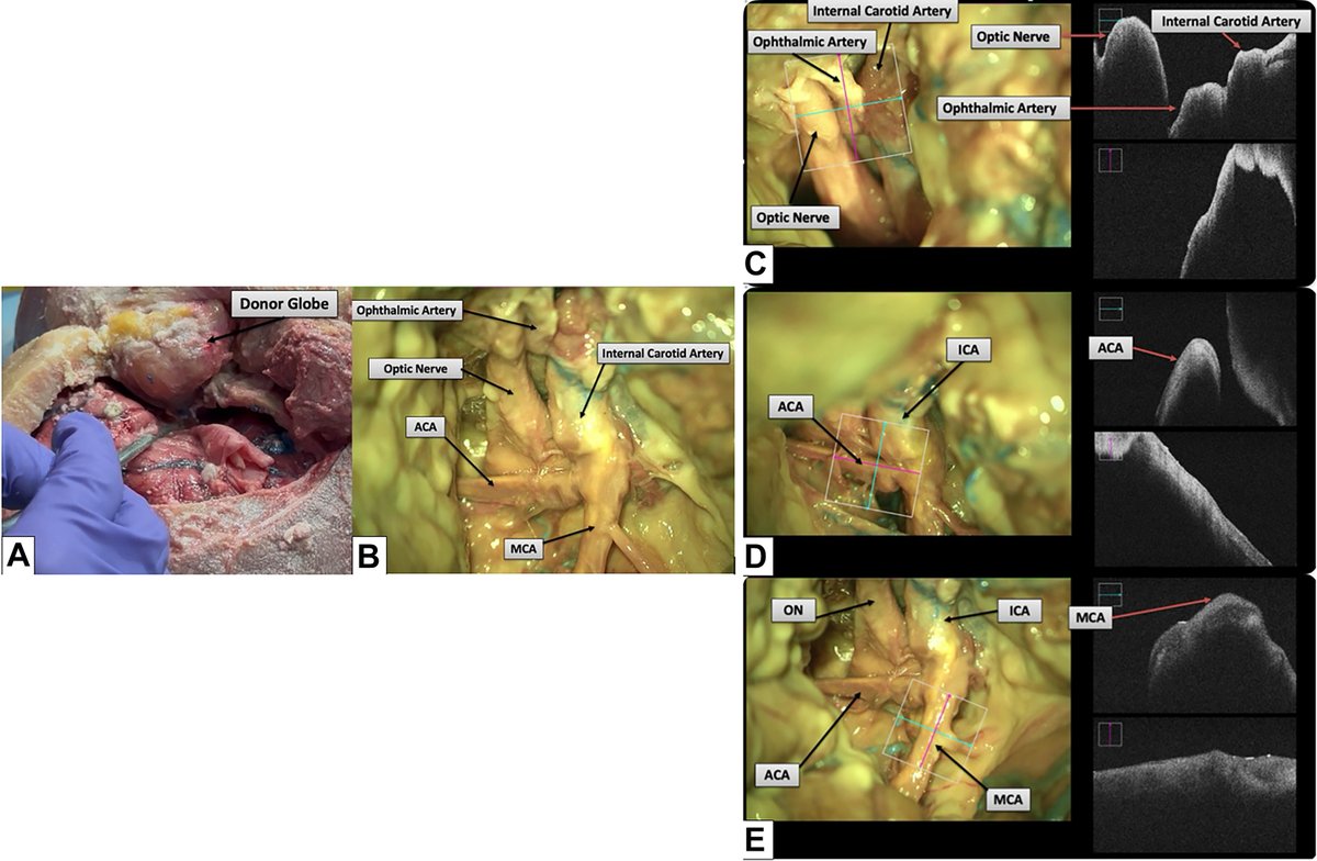 AAOjournal's tweet image. Zero warm ischemia time in whole-eye transplantation through retrograde extracorporeal perfusion
ow.ly/skK150YChYM
#ophthalmology