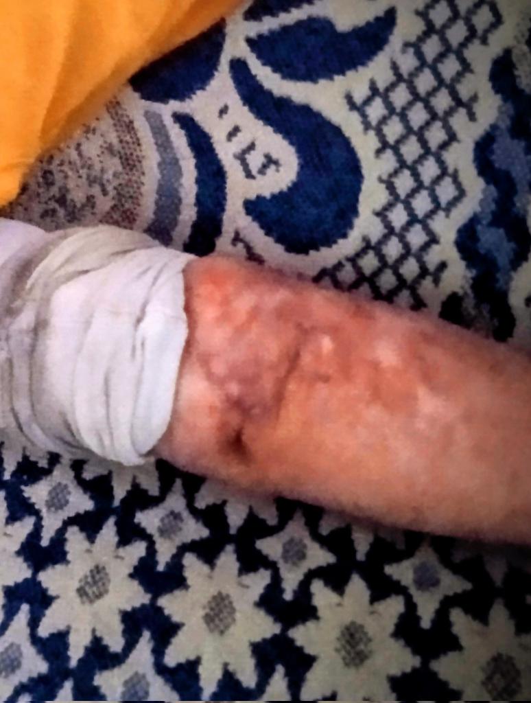 She lost her father when she was one and a half years old. 
Now she's a little older, to know that he'll never come back. 
She is now asking for your support so that she can continue her treatment. To alleviate her pain that hides beneath her clothes Please support her.