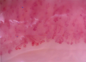 ReumatologiaJ's tweet photo. 🔬 Nailfold capillaroscopy is a key non-invasive tool in rheumatic diseases—not only in SSc but across the spectrum 
👉https://t.co/SpA1Po9aKg
This review highlights its diagnostic value and the need for standardization.
📸 See attached images for typical patterns. https://t.co/FZreCgSO3Q