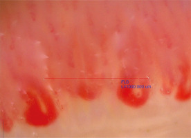 ReumatologiaJ's tweet photo. 🔬 Nailfold capillaroscopy is a key non-invasive tool in rheumatic diseases—not only in SSc but across the spectrum 
👉https://t.co/SpA1Po9aKg
This review highlights its diagnostic value and the need for standardization.
📸 See attached images for typical patterns. https://t.co/FZreCgSO3Q
