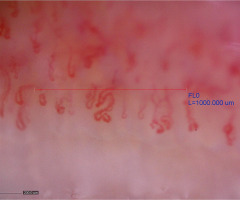 ReumatologiaJ's tweet photo. 🔬 Nailfold capillaroscopy is a key non-invasive tool in rheumatic diseases—not only in SSc but across the spectrum 
👉https://t.co/SpA1Po9aKg
This review highlights its diagnostic value and the need for standardization.
📸 See attached images for typical patterns. https://t.co/FZreCgSO3Q