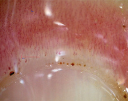 ReumatologiaJ's tweet photo. 🔬 Nailfold capillaroscopy is a key non-invasive tool in rheumatic diseases—not only in SSc but across the spectrum 
👉https://t.co/SpA1Po9aKg
This review highlights its diagnostic value and the need for standardization.
📸 See attached images for typical patterns. https://t.co/FZreCgSO3Q