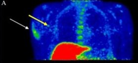 Hey <a href="/NightShiftMD/">Dr. Brian Goldman</a> what's that big chunk of glowing stuff in the arm that you missed on this image?

pubmed.ncbi.nlm.nih.gov/34541458/

Also, were you paid for your tweet?