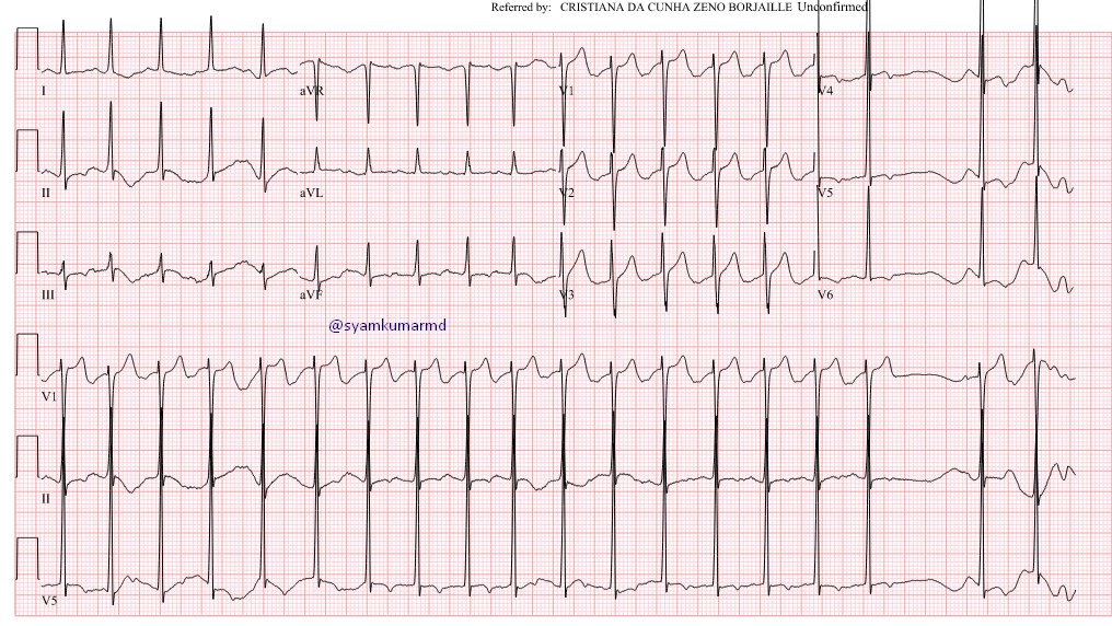 syamkumarmd's tweet image. 37 yrs old male, with minimal symptoms and noted to have severe LV dysfunction. Normal Cath and LVEDP is 3!. What could be the coause and where do you localize the problem? #EPeeps