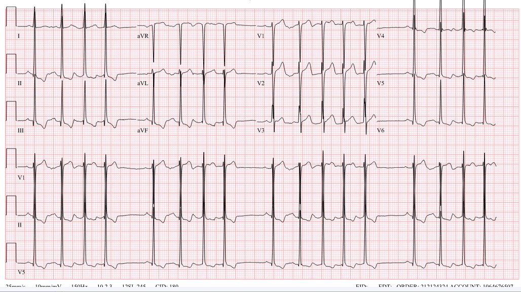 syamkumarmd's tweet image. 37 yrs old male, with minimal symptoms and noted to have severe LV dysfunction. Normal Cath and LVEDP is 3!. What could be the coause and where do you localize the problem? #EPeeps