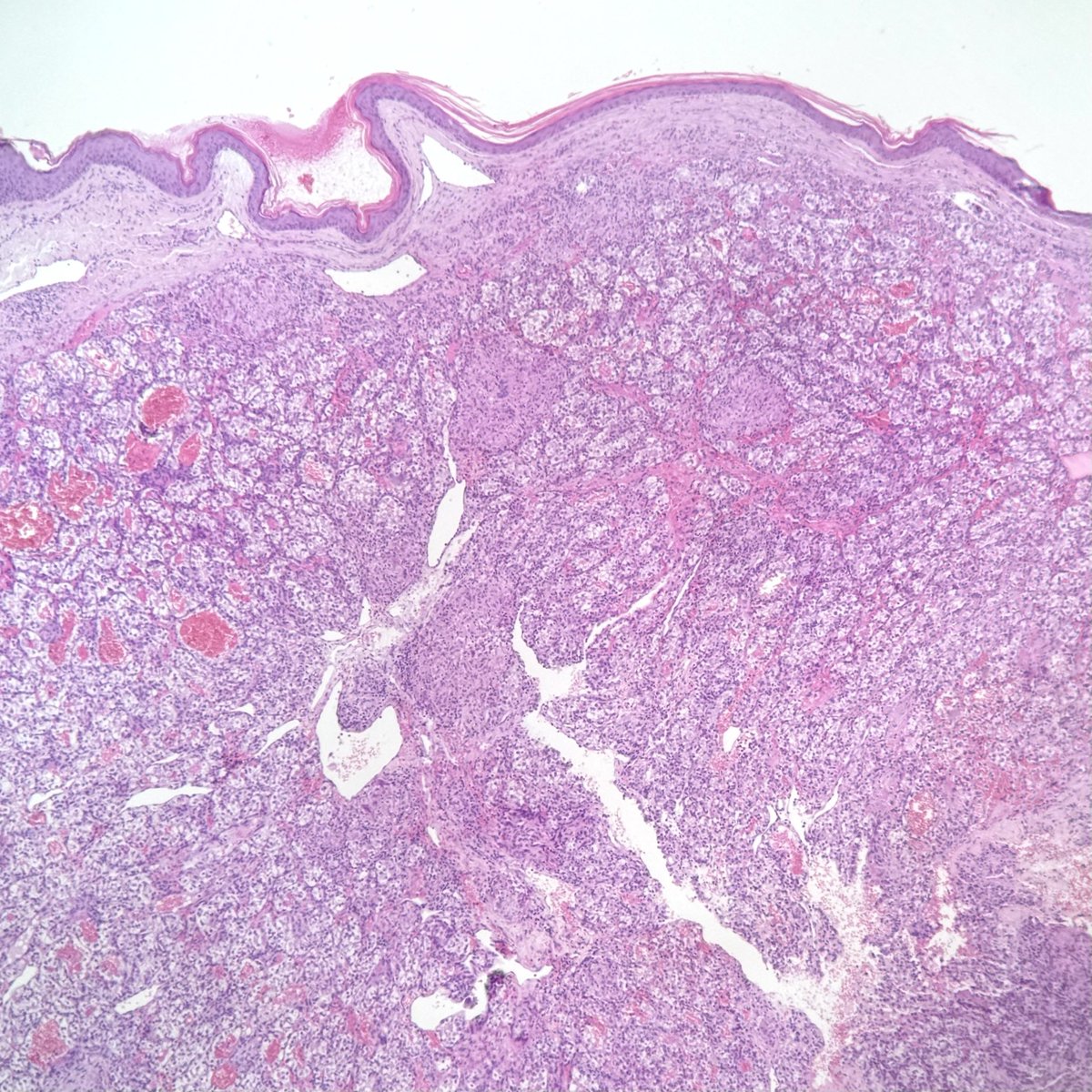 pathoblog's tweet photo. 🧵 1/6
A nodule on the face. Sent as a skin biopsy. No clinical history provided. Spoiler: this is NOT a primary skin tumor. 👇

#pathtwitter #dermpath #uropath #pathology https://t.co/5g3jzSJuxn