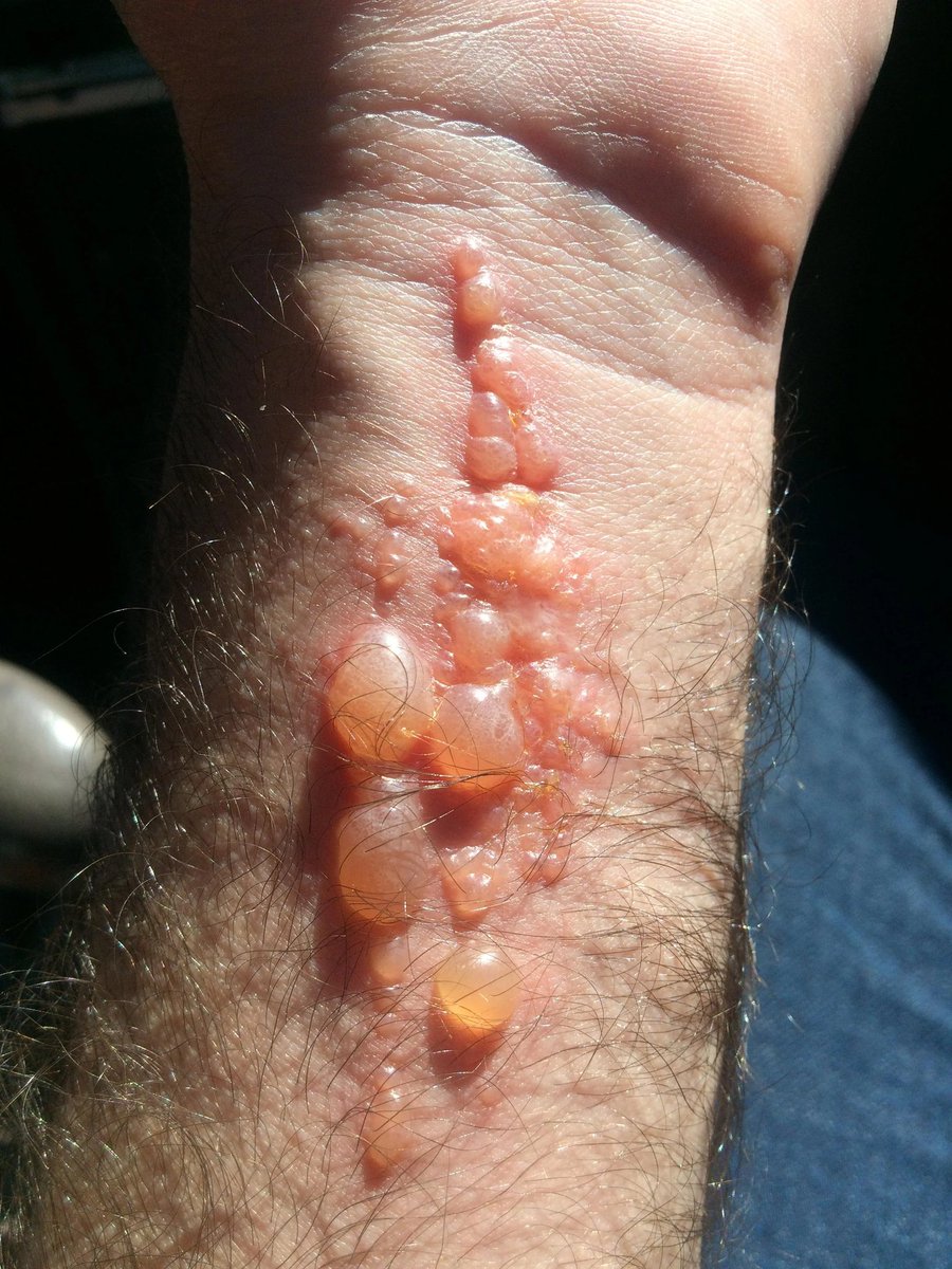 drabdulhameed07's tweet photo. He developed these fluid-filled blisters… in a LINE 😳
What’s the diagnosis? https://t.co/ipOoAselLu