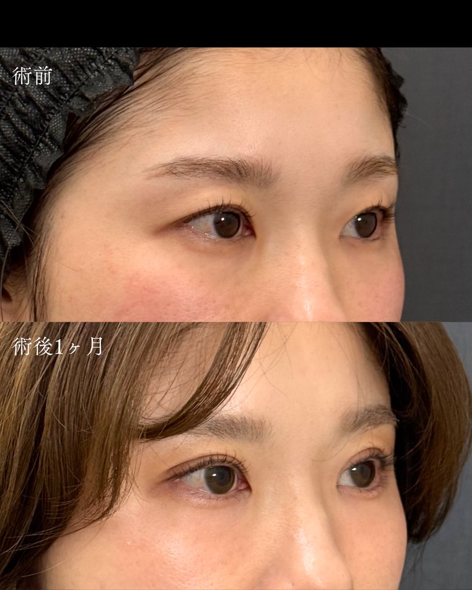 ApollonClinic's tweet photo. 埋没法で���二重を改善👀
瞼に隠れた二重ライン、埋没法で幅を変えることでこんなに印象が変わります✨ https://t.co/WLsmZEX1Ad