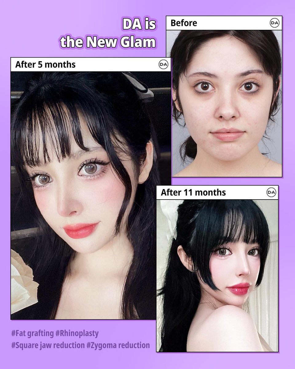 daprs1's tweet image. ✨Subtle, refined, and beautifully harmonious.
🔹 Personalized consultation
🔹 Advanced surgical techniques
🔹 Natural-looking outcome
Because the best results don’t change who you are, they elevate it.

☎️+82 10 9763 7112 ENG/ESP

#beforeandafter #model #DAClinic #seoul #idol