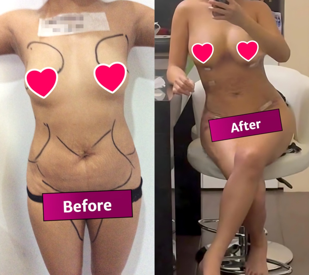 RGuanzonMD's tweet photo. Result of a breast fat transfer, a Brazilian Butt Lift, a 360-degree tummy liposuction, a thigh liposuction etc. by Dr. Raul Guanzon in Greenhills, San Juan, Metro Manila.

#liposuction #bbl #brazilianbuttlift #breastfattransfer #360Lipo #360liposuction https://t.co/f4Sq3vLz1y