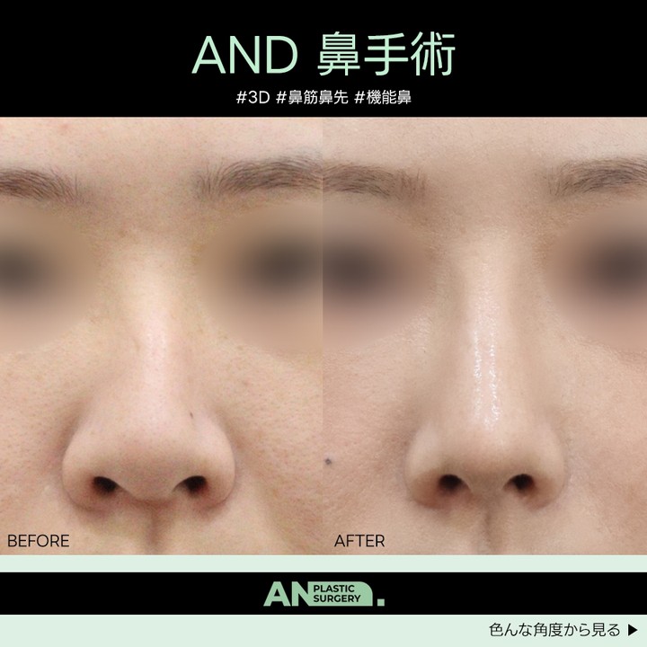 韓国🇰🇷👃🏻鼻専門医👃🏻AND(エンド)整形外科 tweet media