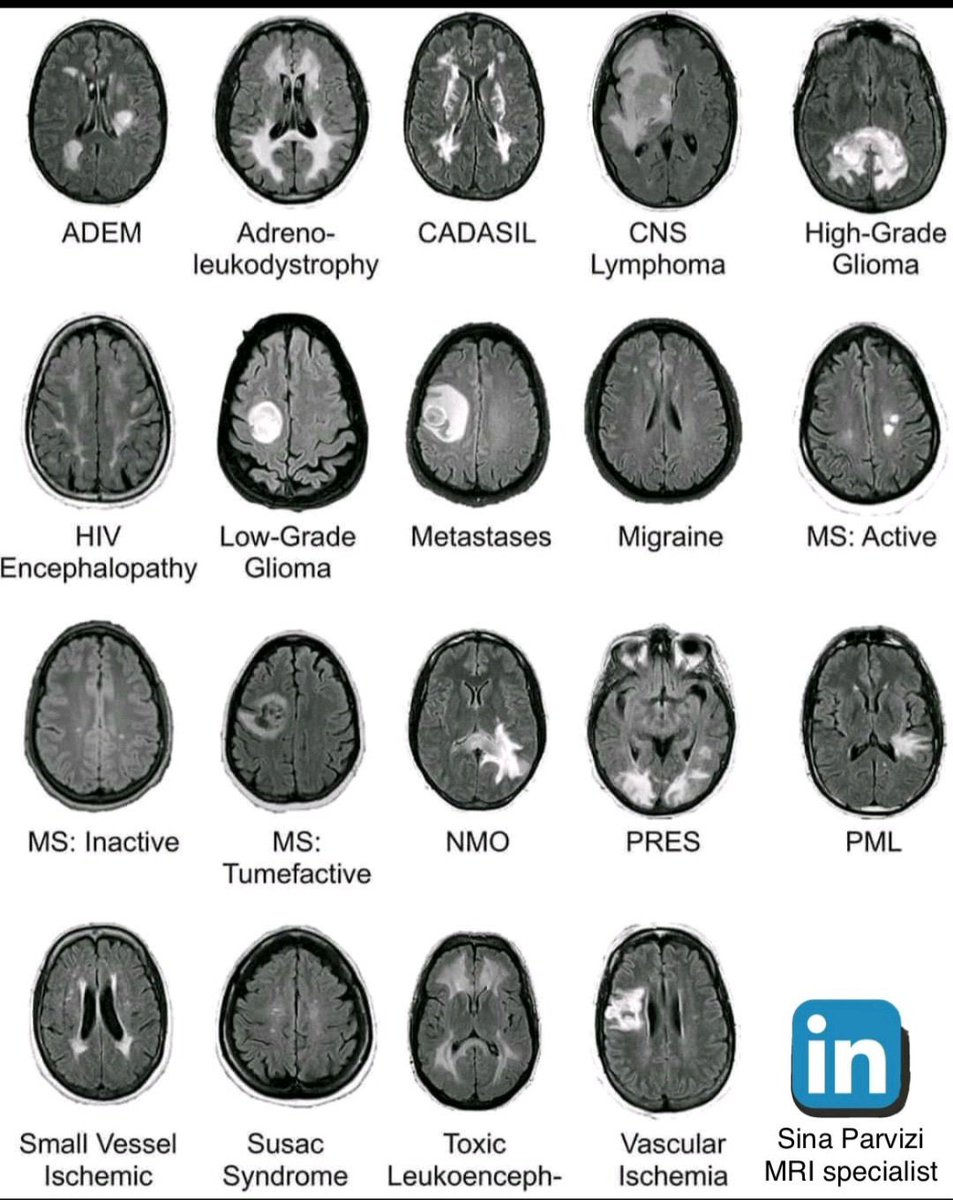 DrAyubaD's tweet photo. Common  lesions (including tumors) on FLAIR MRI. 

A time saver I wish I knew earlier(for residents and medical students)

Press like so everyone sees this ❤️.   #MedX https://t.co/Tp8kSxhuIn