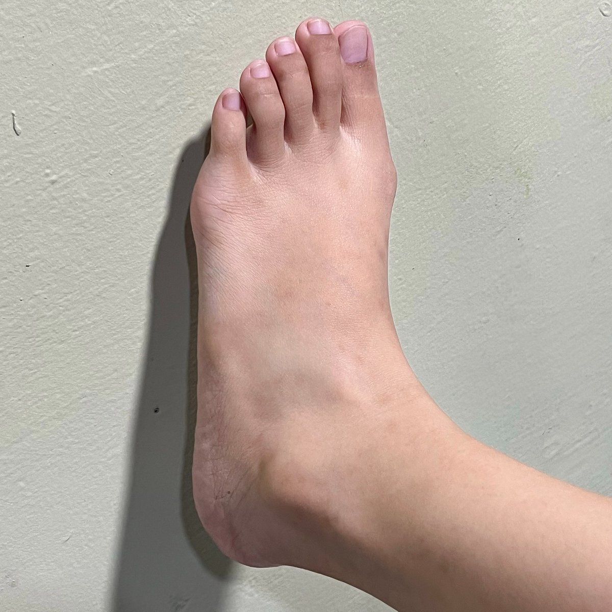 amndalune's tweet photo. lagi di fase rajin-rajinnya ngerawat diri sendiri 😭 pokoknya pengen beneran glow up, bukan cuma muka tapi sekujur badan.

Nih hacks buat yang punya bekas luka &amp; stretch mark tapi males ribet 🧵

cuma butuh 2 step

Before                                         After https://t.co/MSWuObDYXe