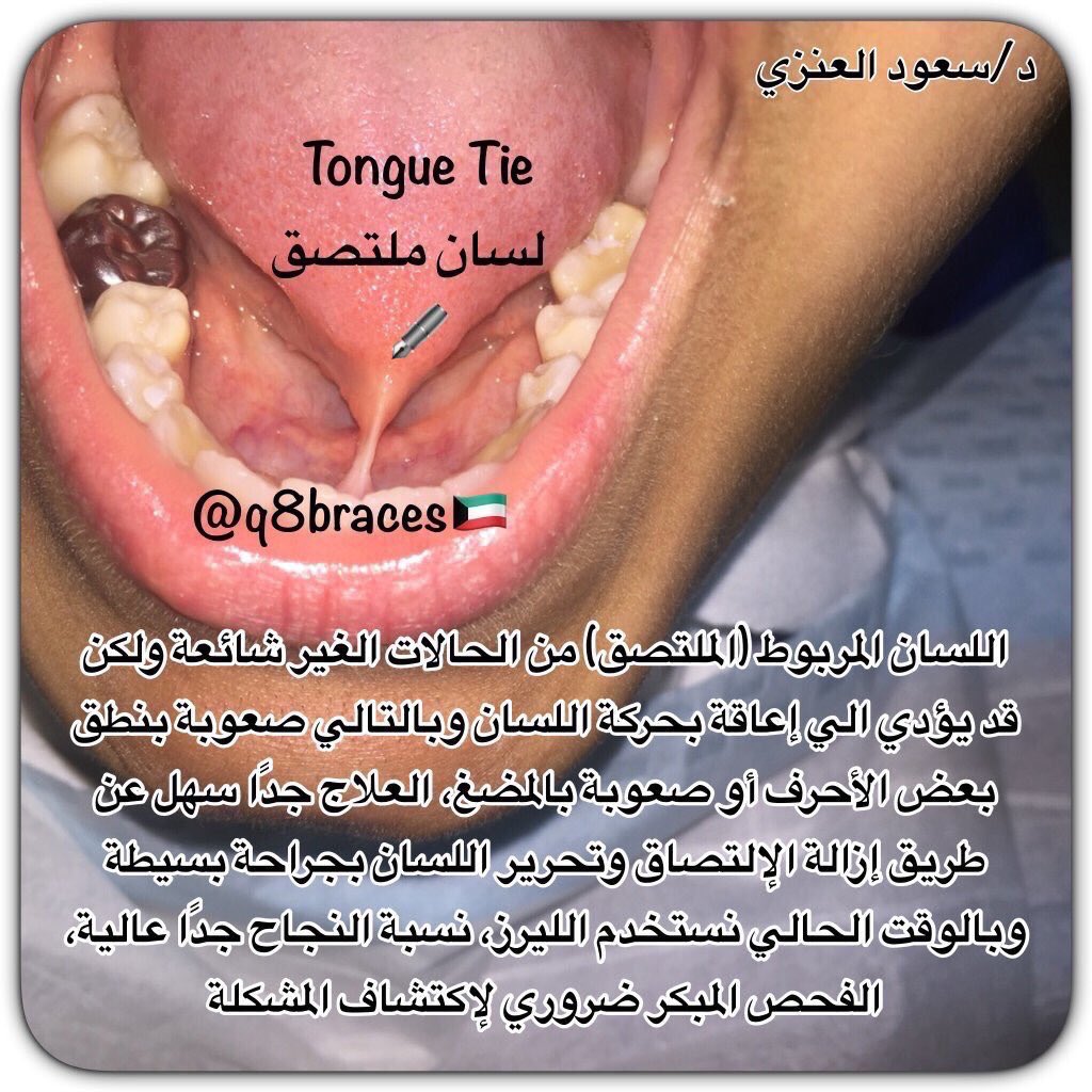 q8braces's tweet photo. يعاني بعض #الأطفال من حالة إلتصاق اللسان (#الصورة) التشخيص بعمر صغير يؤدي إلي تفادي مشاكل بالمستقبل منها صعوبة بنطق بعض الأحرف وظهور فتحات بين #الأسنان. 
#الحالة شخصتها بعيادتي لمراجعة عمرها ١٣ سنة تعاني من اللسان الملتصق علاجها كان بسيط بقص الزيادة (عن طريق الليزر وبدون ألم) .. https://t.co/2OyqFU83Lv