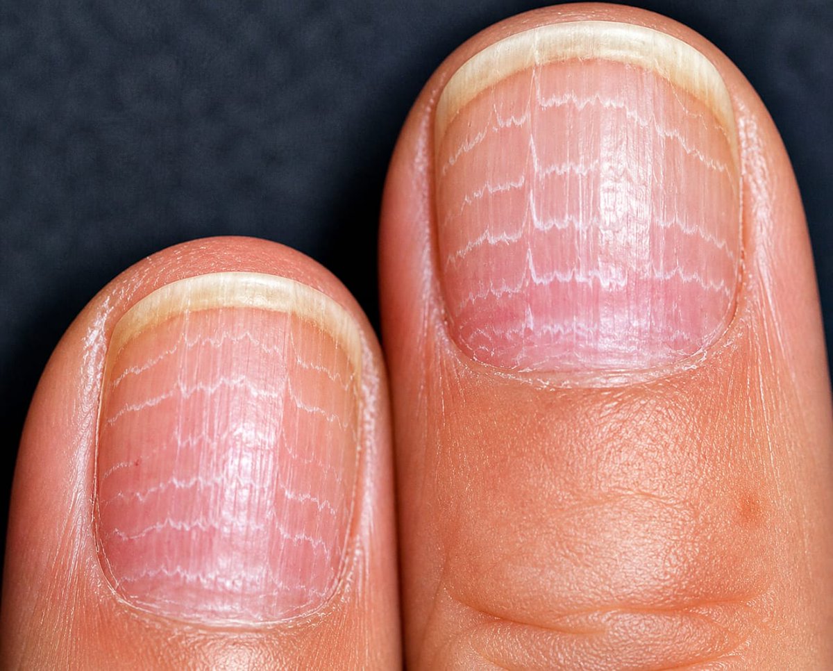 IhabFathiSulima's tweet photo. An Oncology Patient received like 7 or 8 Cycles of Chemotherapy.
What are those Pseudo ECG lines on Nails? https://t.co/5IXwF1iCcf