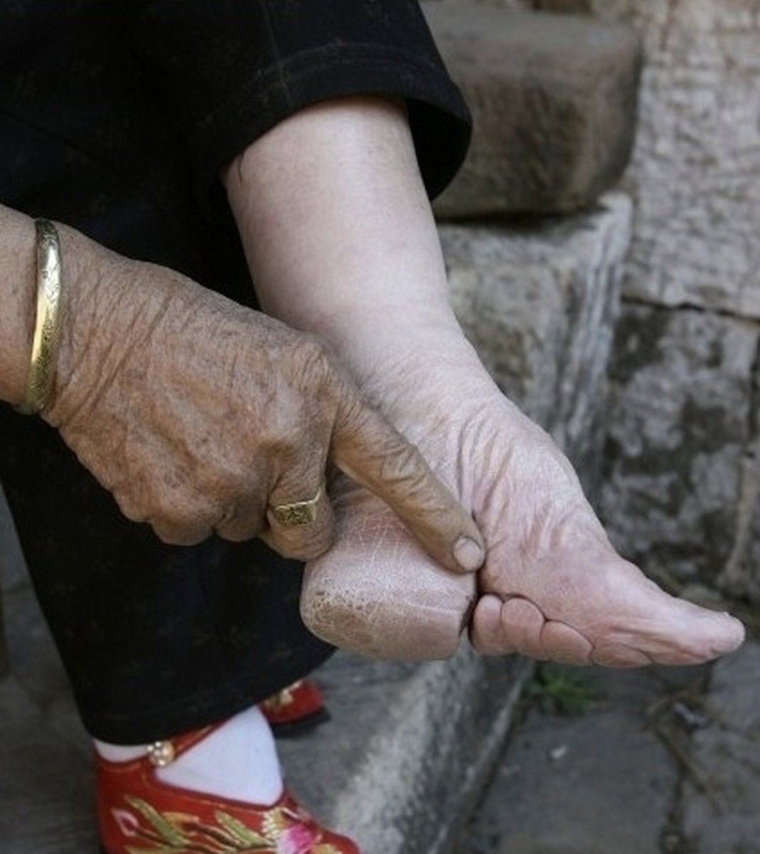 mandarinbj's tweet image. In ancient China, many women were expected to bind their feet, a practice known in Chinese as guǒ xiǎo jiǎo (裹小脚). It was an incredibly cruel cultural tradition. #mandarin #chineseculture