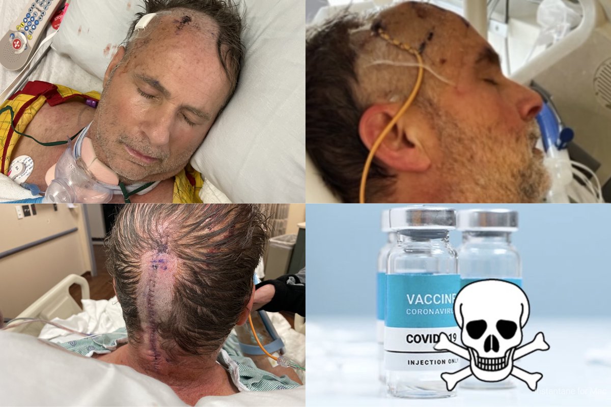 covidjabstroke's tweet image. The scars are a constant reminder of the trauma from emergency brain surgery, tracheotomy, feeding tube etc... required to save my life from the risky covid jab, Dr verified.  I didn’t want it but was threatened with my job  &amp;amp; it would have never happened if I wasn't intimidated