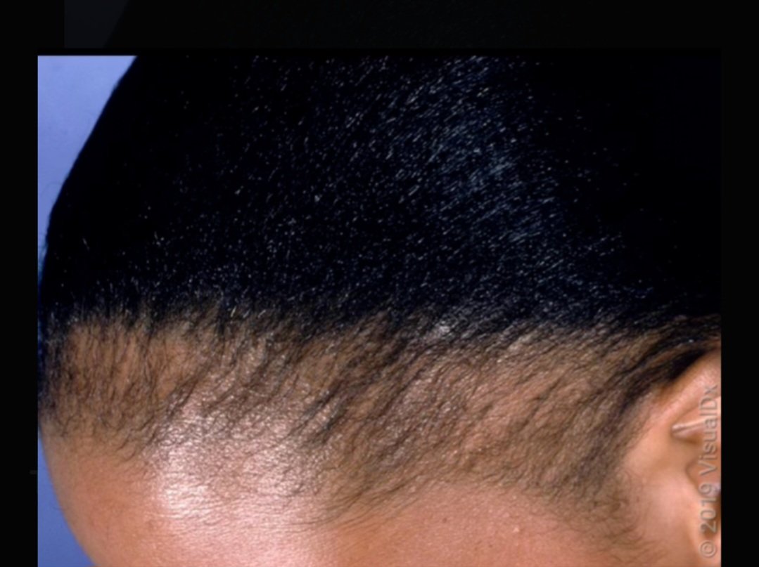 DrStuff2's tweet photo. Have you noticed more women losing their hair and turning to wigs or shaving their heads? 

 It might interest you to know that hair loss in women (alopecia) has many underlying causes.

While it can be distressing, understanding the reasons is the first step toward addressing it.

Check the next post, bookmark  and repost