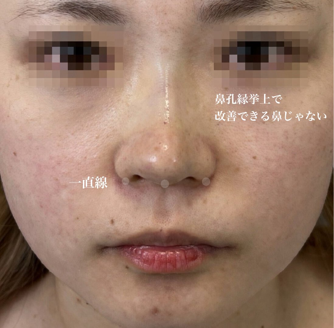 鼻孔縁挙上術をする時は、鼻翼包茎型は効果てきめん僕イケメンだが、鼻翼薄型に行うと鼻孔縁が吊り上がった豚鼻が爆誕する。

また鼻のACRを整えたい為に鼻孔縁挙上するのは愚策で、結局、短鼻が改善されなければほとんどの団子鼻には無力なのである