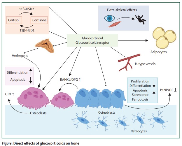 TheLancetEndo's tweet photo. Individuals on long-term oral #glucocorticoid treatment display an estimated prevalence of #osteoporosis or #fractures as high as 30–50%, rendering glucocorticoid therapy the most common cause of secondary and iatrogenic osteoporosis https://t.co/ZmMFAOJSc4
#BoneHealth https://t.co/DNUocIbGMq