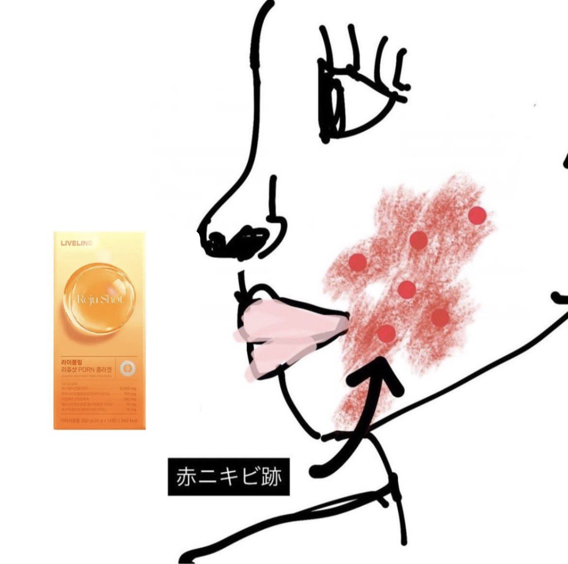 jimansi_tati's tweet photo. ニキビ治っても濃い跡だけ残るって人はこれが効く。使ってたら徐々に薄くなっていくの実感できる。すっぴん美人の水光肌になったの歓喜インナーケア大事 https://t.co/unR21jm41b
