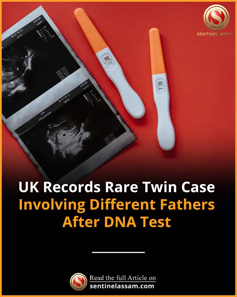 Sentinel_Assam's tweet image. The United Kingdom has reportedly recorded its first known case of a rare biological phenomenon called heteropaternal superfecundation, where twins have different fathers. 

#THeSentinel #UK #Rare