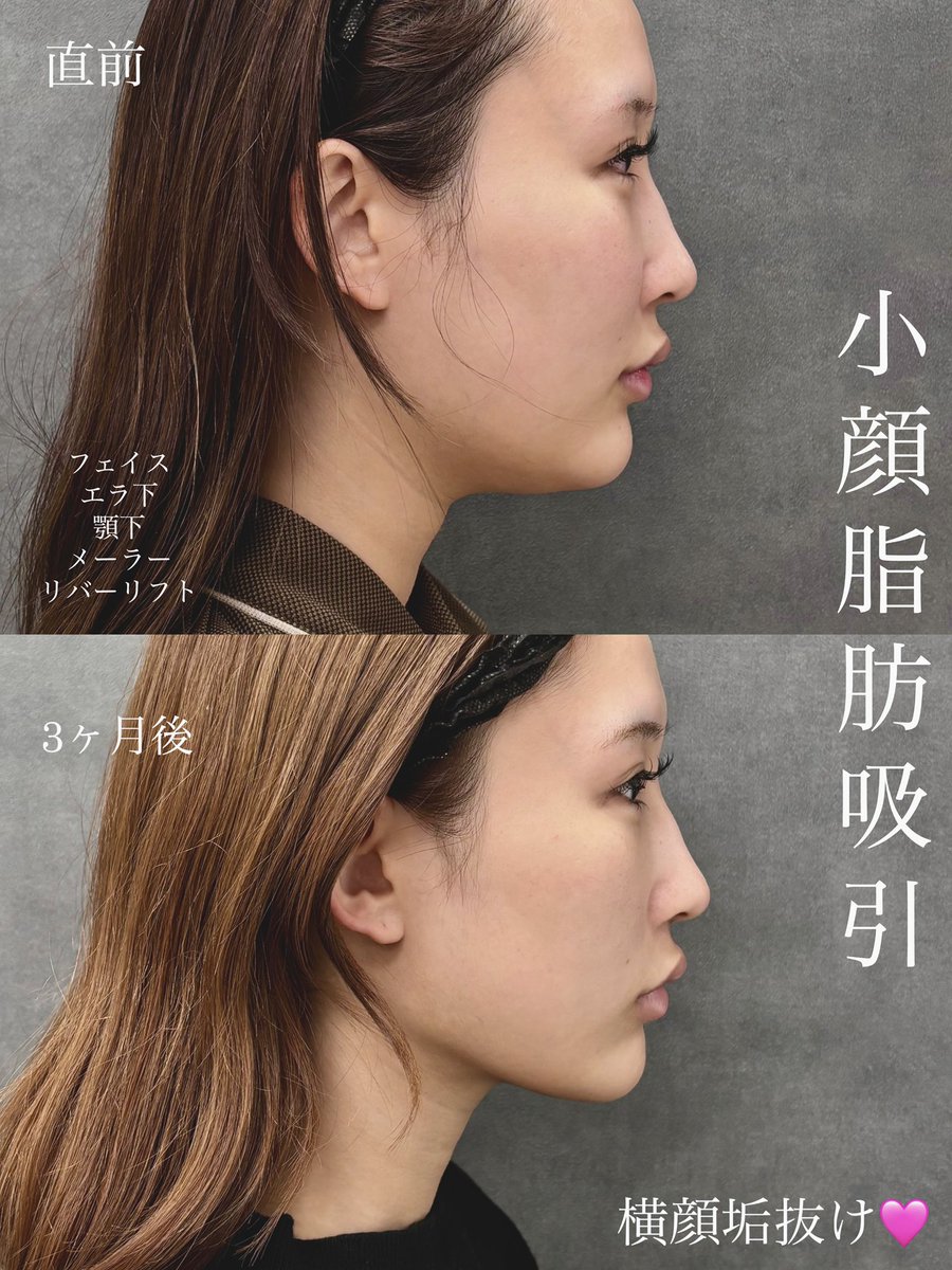 dr__kiya's tweet photo. 【フェイス顎下エラ下脂肪吸引、3ヶ月後経過】
とても綺麗な横顔に✨
フェイスは適度にエラ下顎下はしっかり吸引。
症例はInstagramに沢山載っていますので参考にしてみてください👩‍⚕️
#リバークリニック　#大阪 https://t.co/H1s0hA9d7J