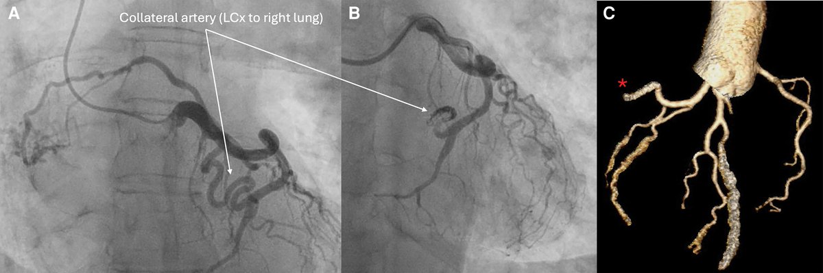 ESC_Journals's tweet image. Management of acute coronary syndrome caused by a rare LCx to R lung (via brachial artery) fistula ow.ly/Xx9O50YTB5t

#EHJCaseReports @Phiso_de @TJ_Yeo @aayshacader @BoldiKovacsMD @SukritiBanthiya @ANazmiCalik @O_Azizy_MD @saramoscatelli7 @EHJCREiC #CardioX