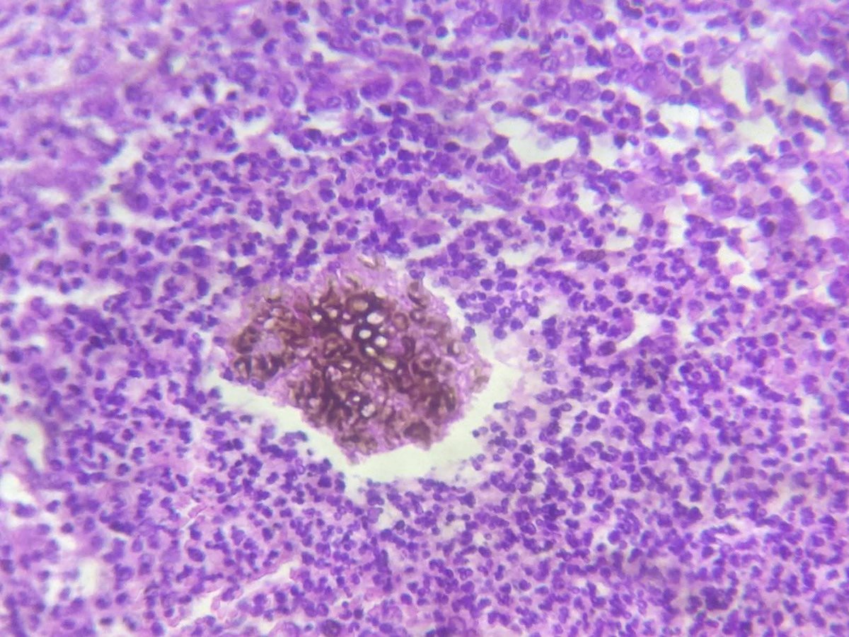 pathphyo's tweet image. A nice Madura foot (Eumycetoma) presenting as a mass in foot. #pathology #dermpath #mycetoma