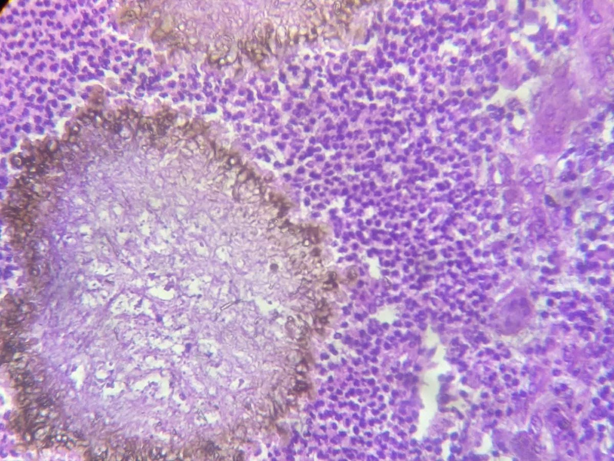 pathphyo's tweet image. A nice Madura foot (Eumycetoma) presenting as a mass in foot. #pathology #dermpath #mycetoma