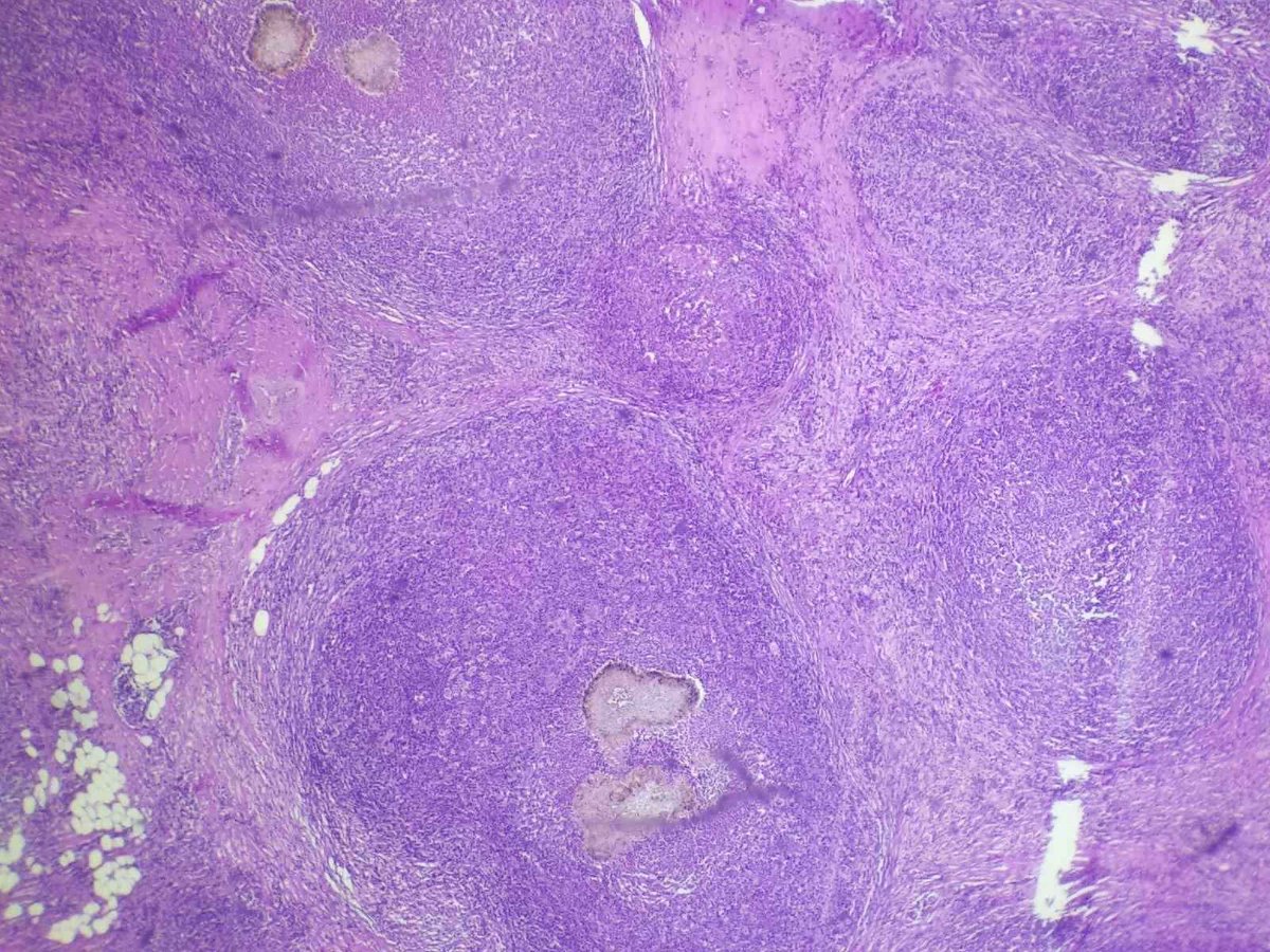 pathphyo's tweet image. A nice Madura foot (Eumycetoma) presenting as a mass in foot. #pathology #dermpath #mycetoma