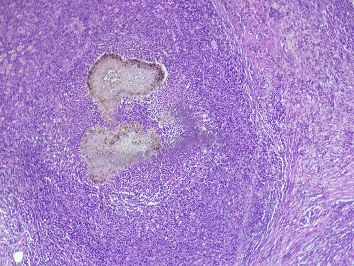 pathphyo's tweet image. A nice Madura foot (Eumycetoma) presenting as a mass in foot. #pathology #dermpath #mycetoma