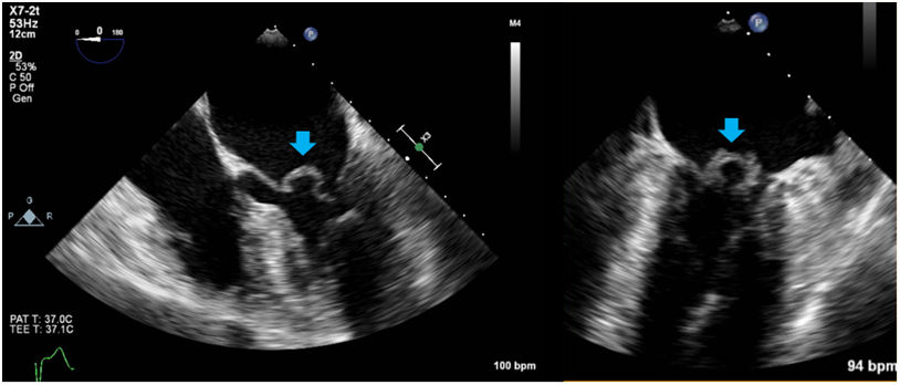 RitikaTuliMD's tweet photo. CardioNugget 🫀

Aortic valve infective endocarditis 
→ infected AR jet hits AML 
→ endothelial injury + seeding 
→ mitral leaflet “mycotic” aneurysm 
(bulges in systole, may rupture → acute MR).

“Mycotic” is a misnomer (William Osler): refers to mushroom-like shape, not fungal cause.

#CardioNugget #MedEd #InfectiveEndocarditis #EchoFirst