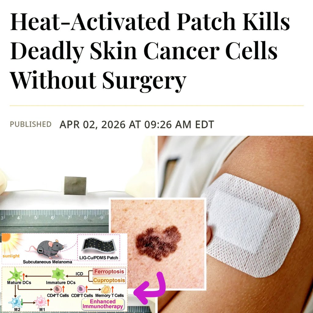 SciTechera's tweet photo. Reminder

ANTI CANCER PROGRESS 

Scientists developed a heat activated wearable patch that can kill melanoma tumors without surgery.

The patch uses laser-induced graphene loaded with copper oxide nanoparticles, releasing cancer killing Cu²⁺ ions when activated at 42°C using a low power laser.

In mouse trials, it achieved 97% tumor reduction within 10 days, while preventing cancer spread beyond the original site.

The system is noninvasive, flexible, and reusable, with no detectable organ toxicity or copper buildup in the body.

The technology combines photothermal therapy, metal-ion cytotoxicity, and localized drug delivery into a single skin-applied device.

Human trials have not yet begun, but the approach could shift cancer treatment from surgery to on-demand wearable therapy.
