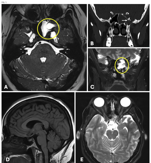 Journal of Neurosurgery tweet media