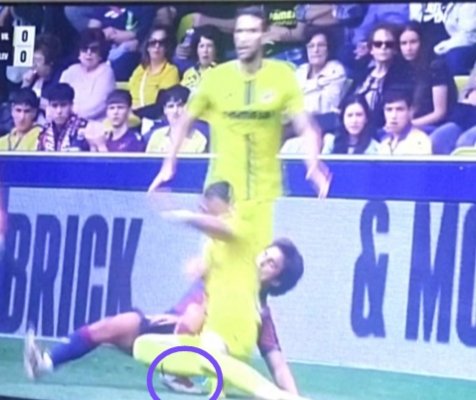 Analysis_Injury's tweet photo. 🚨 Lesión de Carlos Álvarez.

El jugador del @LevanteUD no puede continuar tras esta acción.

Torsión en el tobillo izquierdo compatible con un esguince en la sindemosis.

De confirmarse este diagnóstico, tendría muy difícil jugar lo que queda de temporada. https://t.co/j6TJazvepB