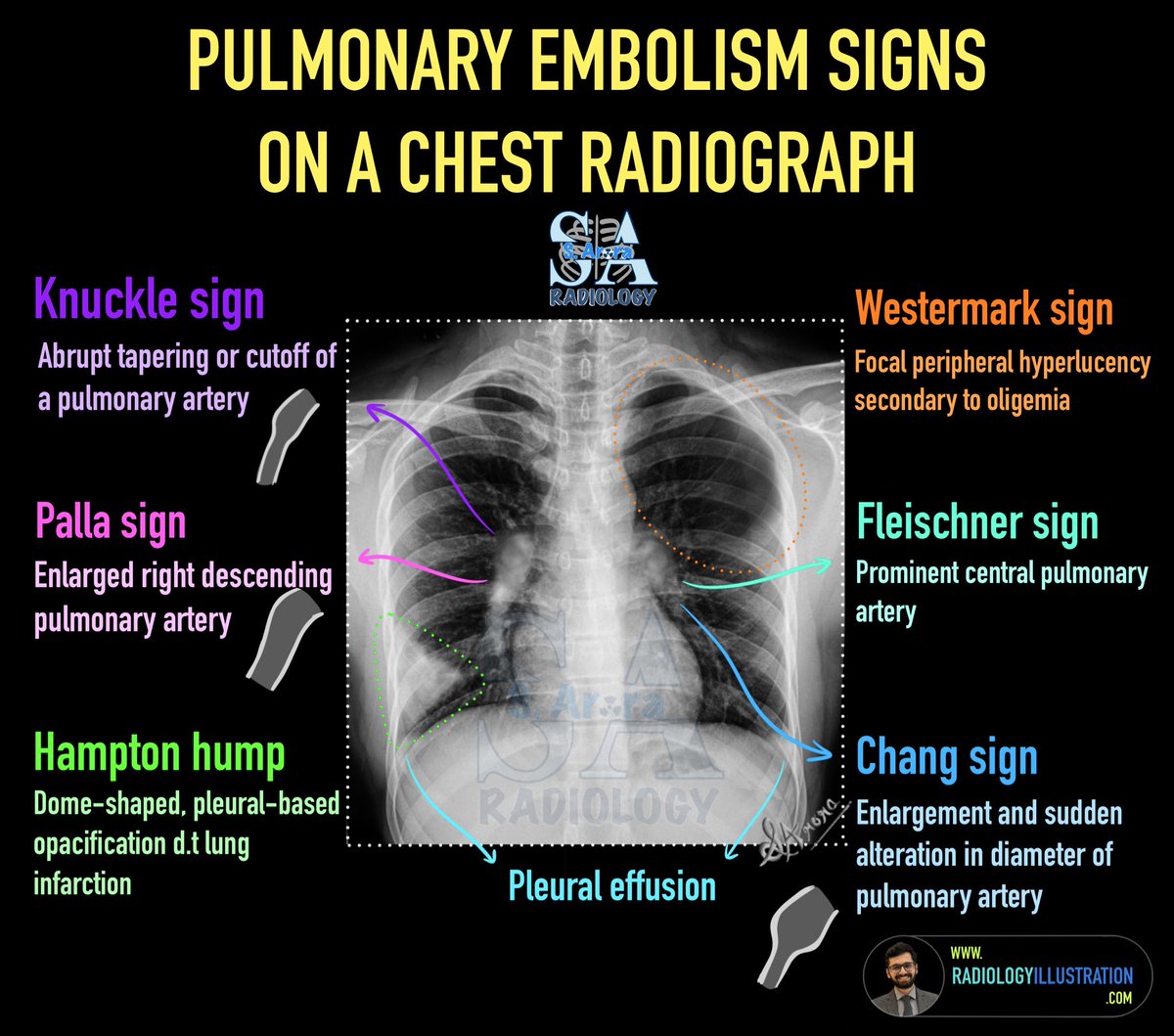 Signs of pulmonary embolism on radiograph. 

#radiology