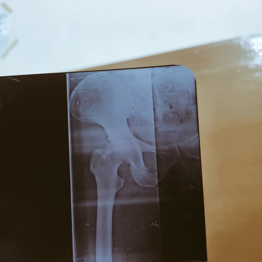TeachingOfIs's tweet image. 57 year-old woman is brought to the emergency after a fall at home. She slipped on the ground. Since the fall, she has been unable to stand or bear weight. X-ray attached..
IS THERE ANY FRACTURE ?? 🤔🤔
#MBBS #DOCTOR
